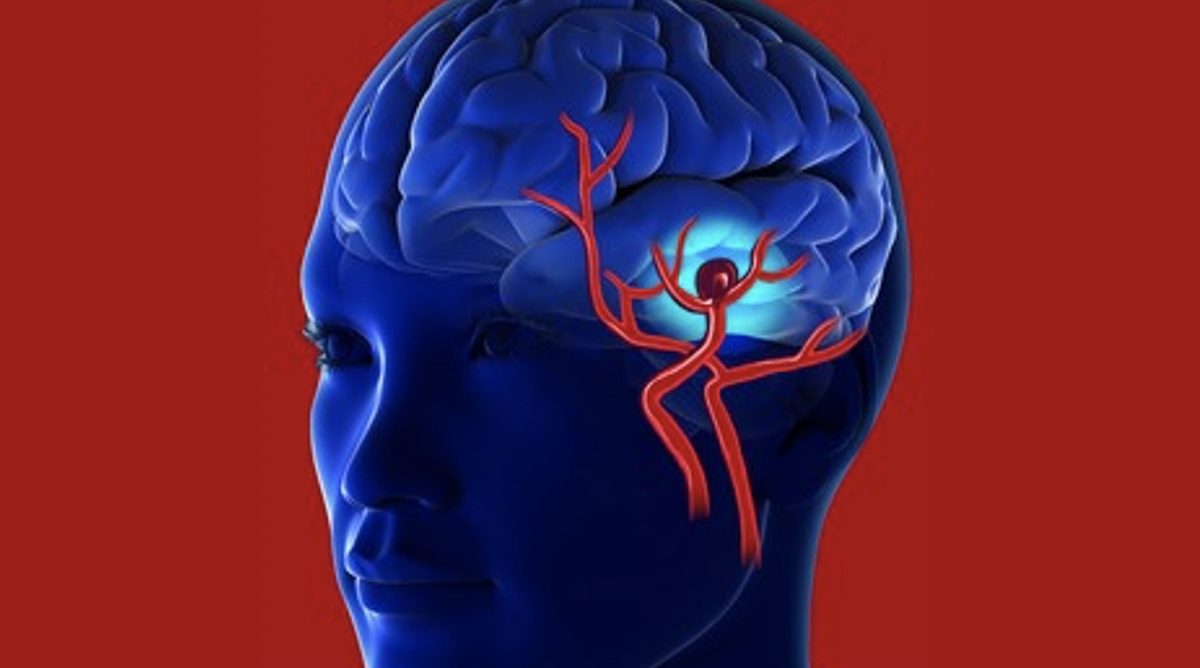 article_image_what-is-brain-aneurysm